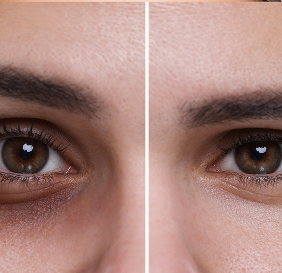 Bright Eyes: The Science Behind Fading Dark Circles