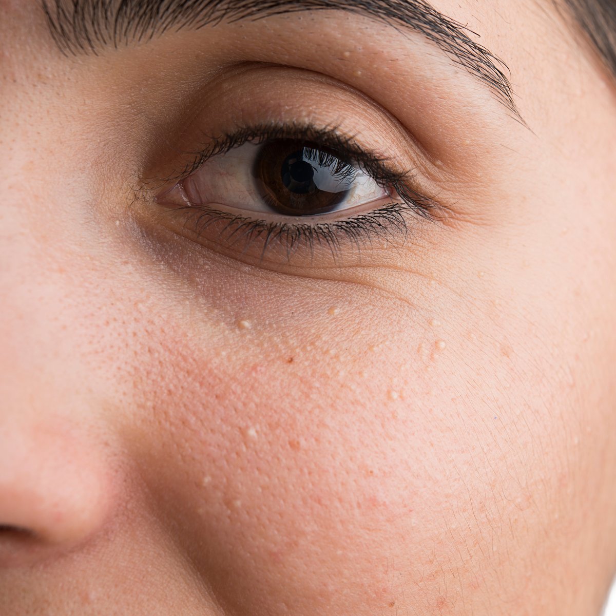 Close-up of small white milia bumps on the skin below a woman's eye
